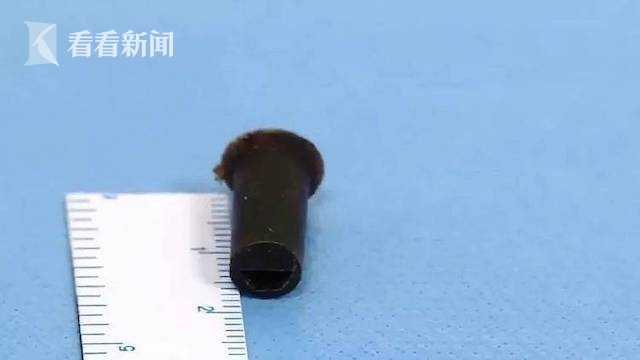 小伙6岁误吞哨子,怕被家长骂瞒了20年!结果...休闲区蓝鸢梦想 - Www.slyday.coM 小伙6岁误吞哨子,怕被家长骂瞒了20年!结果...休闲区蓝鸢梦想 - Www.slyday.coM