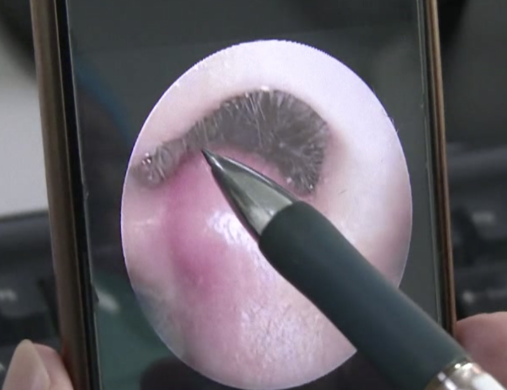 深圳8岁男童挖鼻孔竟致颅内感染!这个坏习惯要改休闲区蓝鸢梦想 - Www.slyday.coM 深圳8岁男童挖鼻孔竟致颅内感染!这个坏习惯要改休闲区蓝鸢梦想 - Www.slyday.coM