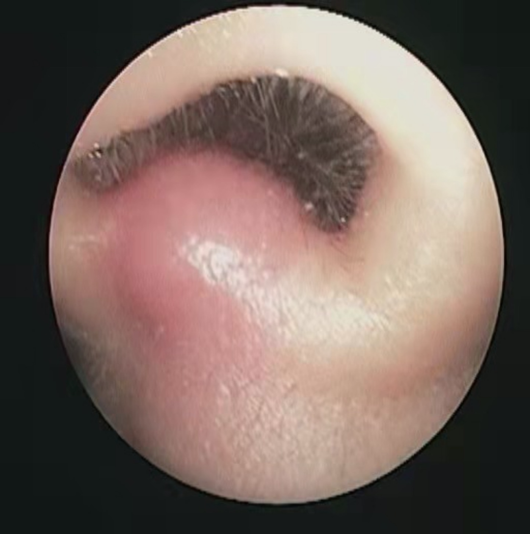 8岁男童挖鼻孔竟致颅内感染!这个坏习惯要改休闲区蓝鸢梦想 - Www.slyday.coM 8岁男童挖鼻孔竟致颅内感染!这个坏习惯要改休闲区蓝鸢梦想 - Www.slyday.coM