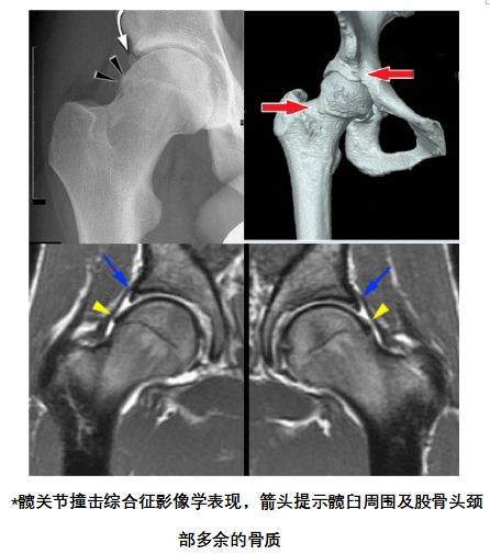 对于怀疑髋关节撞击综合征的就诊者,通常需要首先进行髋关节x线片