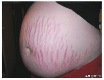 新妈妈有妊娠纹怎么办？平时注意这几个细节，有助于消除妊娠纹