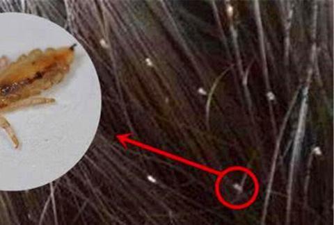 过去农村人人有虱子 现在虱子为何消失不见