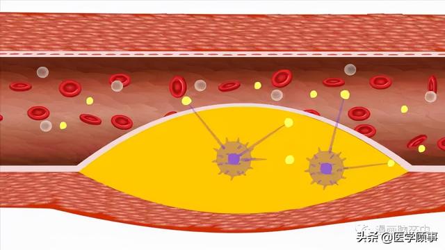 关于脑卒中,这是我看过的最清楚的科普休闲区蓝鸢梦想 - Www.slyday.coM 关于脑卒中,这是我看过的最清楚的科普休闲区蓝鸢梦想 - Www.slyday.coM