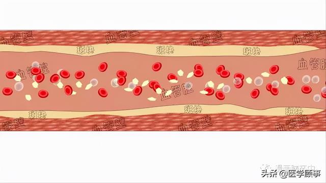 关于脑卒中,这是我看过的最清楚的科普休闲区蓝鸢梦想 - Www.slyday.coM 关于脑卒中,这是我看过的最清楚的科普休闲区蓝鸢梦想 - Www.slyday.coM