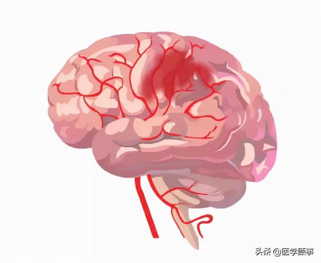 关于脑卒中,这是我看过的最清楚的科普休闲区蓝鸢梦想 - Www.slyday.coM 关于脑卒中,这是我看过的最清楚的科普休闲区蓝鸢梦想 - Www.slyday.coM