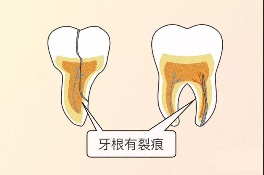 隐形杀手牙隐裂是怎么回事