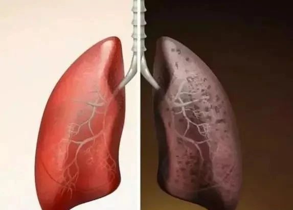 长期抽烟的人若没有2凸3痛说明肺还算健康
