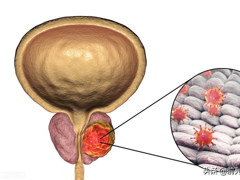 前列腺炎如何分辨是有菌还是无菌？