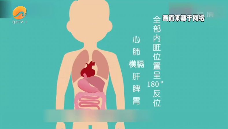 泉州市中医院微创普通外科主任医师 庄阳辉内脏反位的发生是比较少见