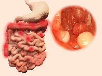 洛阳东大肛肠医院查出这种肠息肉让人不省心