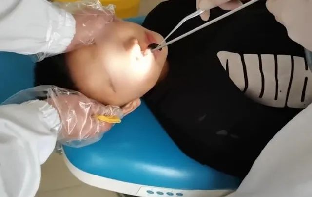 食物进鼻腔里 8cc9-70bde888cc2697c7522085b470b4ecea.jpg