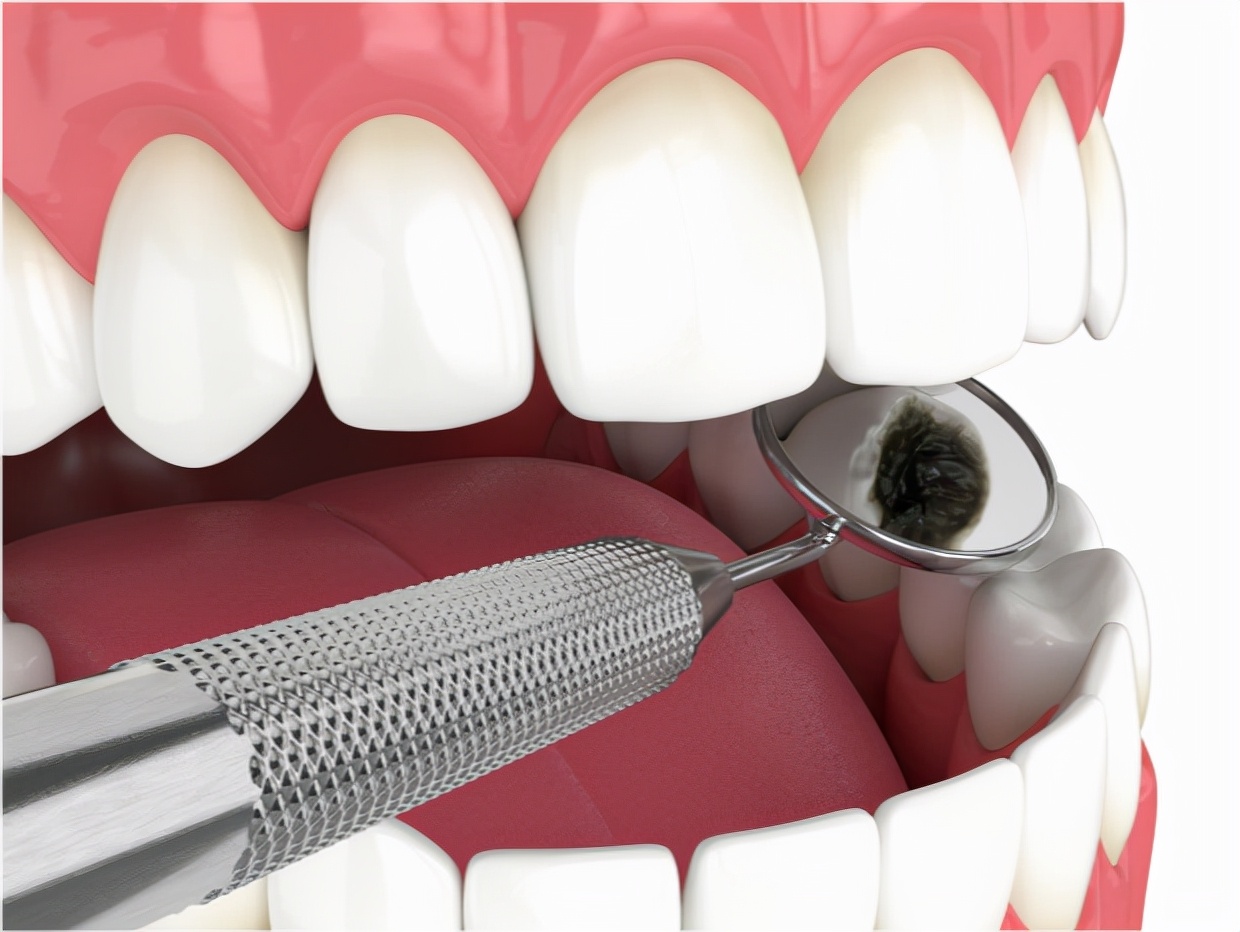 牙齿“结石”导致口腔异味怎么办？教你4招，或能有效去除它！|牙结石|结石|口腔_新浪新闻