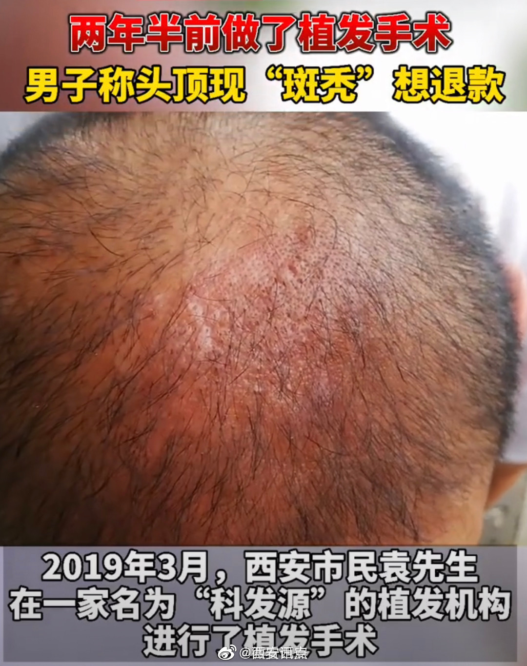 西安男子花4万元在大麦植发后斑秃 维权一年无结果(图4)