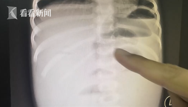 1岁女童误把网红玩具当糖吞下 医生紧急手术取出休闲区蓝鸢梦想 - Www.slyday.coM 1岁女童误把网红玩具当糖吞下 医生紧急手术取出休闲区蓝鸢梦想 - Www.slyday.coM