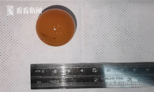 1岁女童误把网红玩具当糖吞下 医生紧急手术取出休闲区蓝鸢梦想 - Www.slyday.coM 1岁女童误把网红玩具当糖吞下 医生紧急手术取出休闲区蓝鸢梦想 - Www.slyday.coM