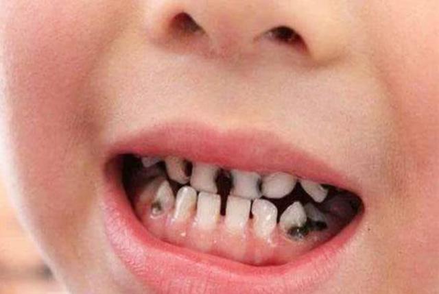 伤害宝宝牙齿的元凶不一定是糖几种危险食物父母总喜欢喂