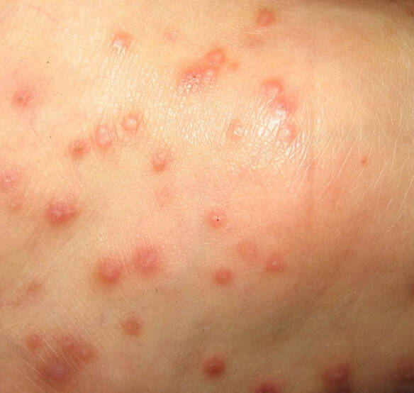皮肤出现湿疹的原因是什么?
