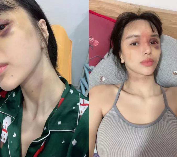 越南超模被爆遭家暴，孕期被丈夫殴打，还把她的头按进马桶里