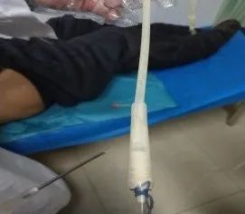 当尿管拔不出来时,你知道是什么原因该如何处理吗?|症