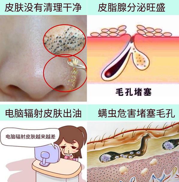 一是卫生问题,就是皮肤清洁不到位,导致毛孔堵塞,皮脂腺分泌油脂不
