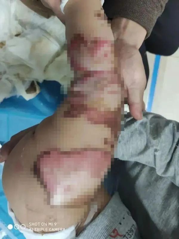 神器变凶器!1岁男童尿床被烧成重伤,只因妈妈做了这件事休闲区蓝鸢梦想 - Www.slyday.coM 神器变凶器!1岁男童尿床被烧成重伤,只因妈妈做了这件事休闲区蓝鸢梦想 - Www.slyday.coM