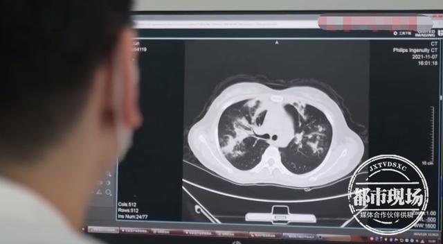 一个多月咳喘不止,女子肺部长满真菌!只因接触了霉变玉米休闲区蓝鸢梦想 - Www.slyday.coM 一个多月咳喘不止,女子肺部长满真菌!只因接触了霉变玉米休闲区蓝鸢梦想 - Www.slyday.coM