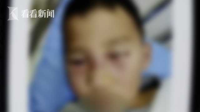 不要随便抠抠!挖鼻孔致发炎 5岁男孩脸肿似“奥特曼”休闲区蓝鸢梦想 - Www.slyday.coM 不要随便抠抠!挖鼻孔致发炎 5岁男孩脸肿似“奥特曼”休闲区蓝鸢梦想 - Www.slyday.coM