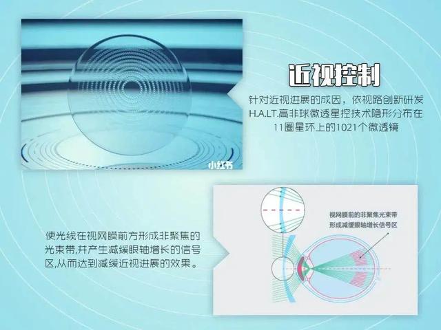 多点近视离焦镜片预防近视的优缺点