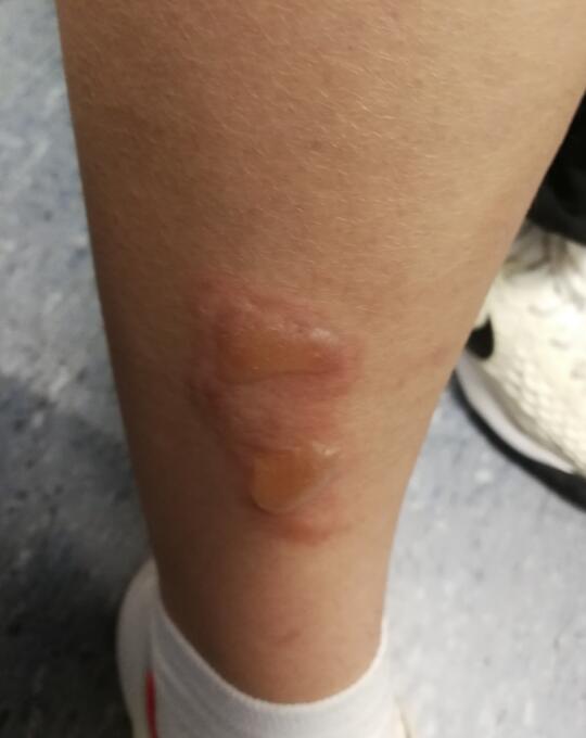 冬天常见的皮肤疾病有哪些?这四种疾病专家建议要预防休闲区蓝鸢梦想 - Www.slyday.coM 冬天常见的皮肤疾病有哪些?这四种疾病专家建议要预防休闲区蓝鸢梦想 - Www.slyday.coM