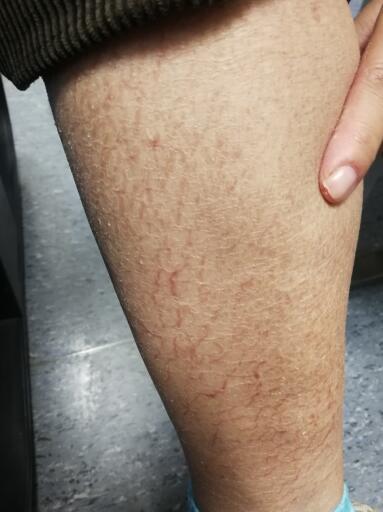 冬天常见的皮肤疾病有哪些?这四种疾病专家建议要预防休闲区蓝鸢梦想 - Www.slyday.coM 冬天常见的皮肤疾病有哪些?这四种疾病专家建议要预防休闲区蓝鸢梦想 - Www.slyday.coM