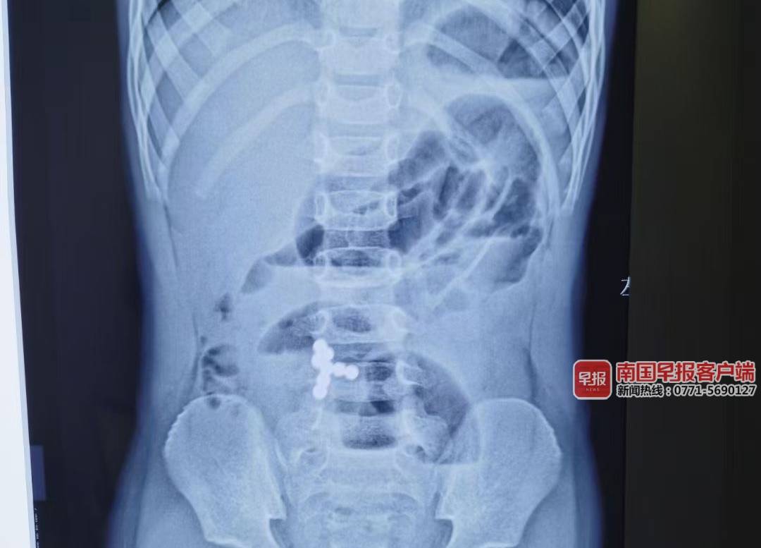 南宁3岁男童误吞8颗磁力珠致肠穿孔,取珠只能开腹.