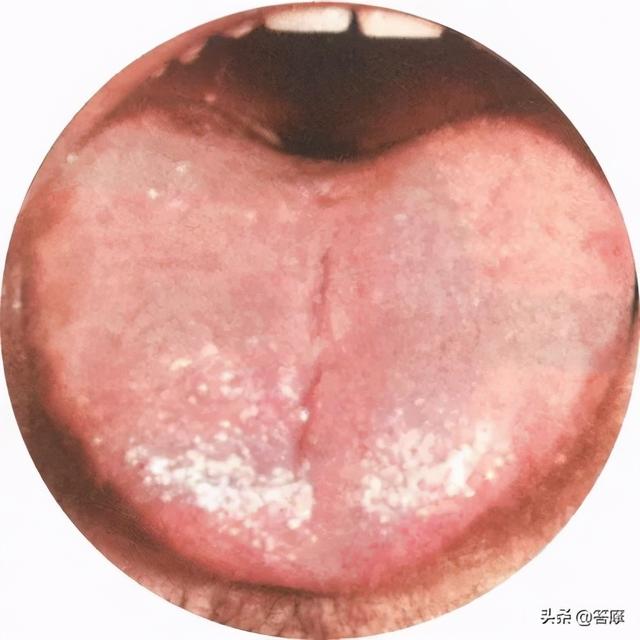 舌质:淡白舌体:胖嫩舌苔:白色