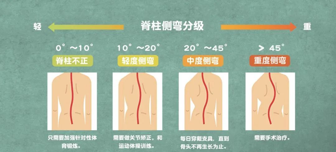 健康|趁寒假带孩子去矫正驼背,高低肩(下|脊柱侧弯|高低肩|背部_新浪
