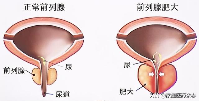 男性"生命腺"危机该如何解除|前列腺炎_新浪新闻