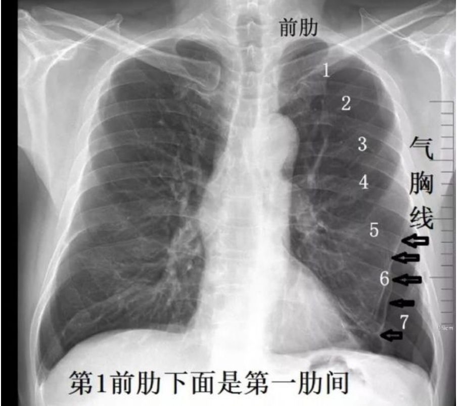 没开玩笑!有人研究大量气胸的保守治疗,发了《新英格兰医学杂志》