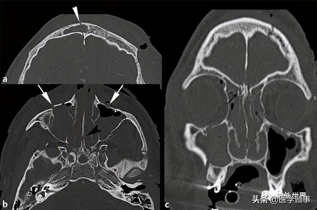 a,ct示额窦内,外侧骨折(箭头,并有颅内积气;b,冠状位示额窦骨折延伸