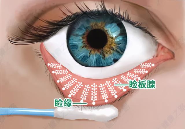 眼干,眼涩,小心是眼皮"堵"住了!经常玩手机的人最易中招