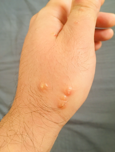 被红火蚁咬过后,在皮肤上产生的红肿和脓疱.受访者供图
