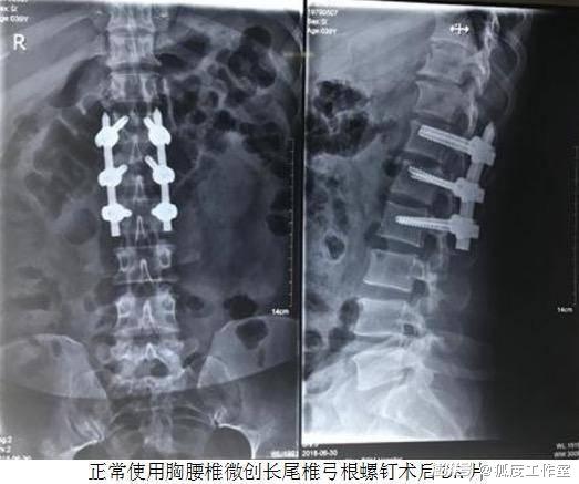用普通钉替代价格高两倍的微创钉 又是医生揭开行业黑幕?