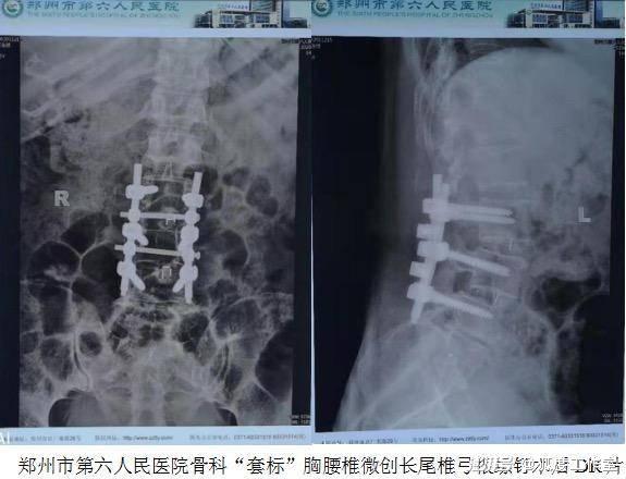 用普通钉替代价格高两倍的微创钉 又是医生揭开行业黑幕?