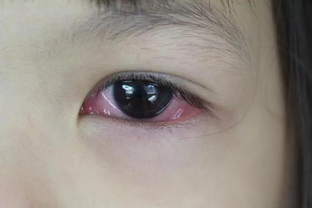正文   有传染性结膜炎的孩子,应该待在家里,直到眼睛不再有分泌物后