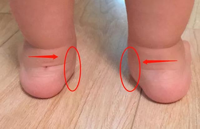 宝宝歪脚走路怎么办当心这种足部畸形