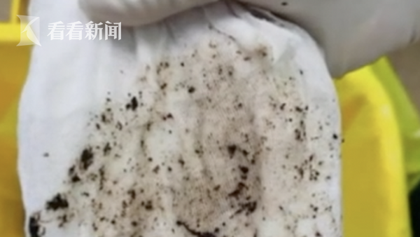 视频|喘气都疼!女子持续咳嗽2年 竟是气管里长了结石休闲区蓝鸢梦想 - Www.slyday.coM 视频|喘气都疼!女子持续咳嗽2年 竟是气管里长了结石休闲区蓝鸢梦想 - Www.slyday.coM