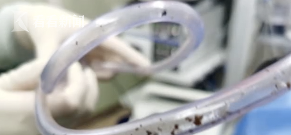 视频|喘气都疼!女子持续咳嗽2年 竟是气管里长了结石休闲区蓝鸢梦想 - Www.slyday.coM 视频|喘气都疼!女子持续咳嗽2年 竟是气管里长了结石休闲区蓝鸢梦想 - Www.slyday.coM