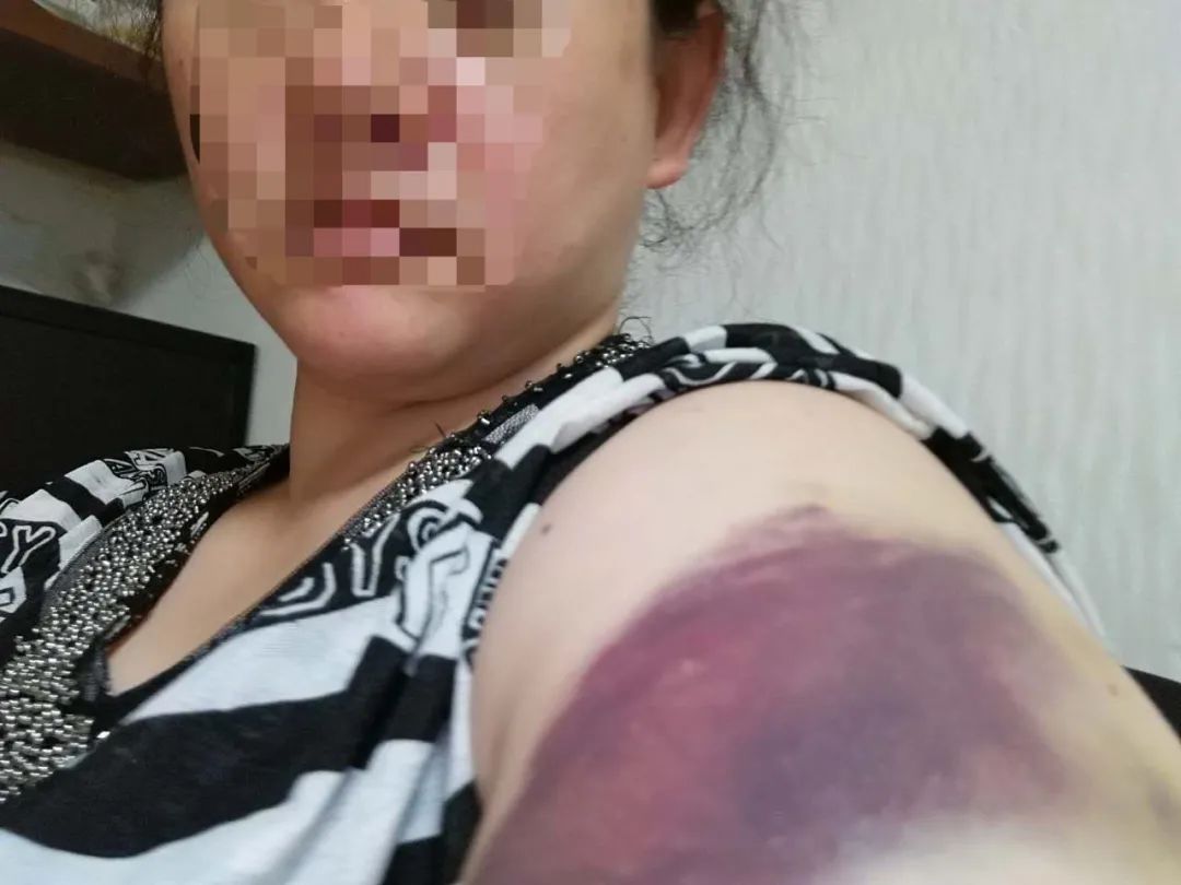 2018年,因为阻止小辉玩游戏,江欣左臂被小辉打伤,深紫色淤青明显。受访者供图