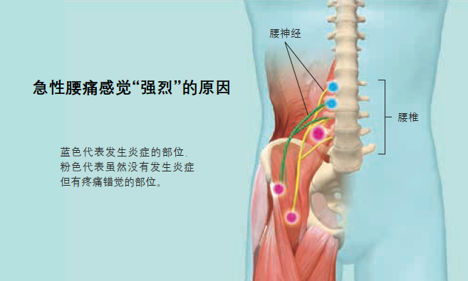 引起急性腰痛的炎症发生时,连接炎症部位的腰神经和其他部位的腰神经