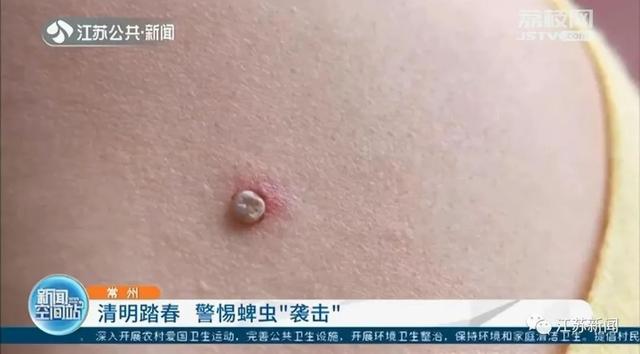 17岁姑娘出现“致命红斑”!此地1死26伤!紧急提醒:清明出游多地有人中招休闲区蓝鸢梦想 - Www.slyday.coM 17岁姑娘出现“致命红斑”!此地1死26伤!紧急提醒:清明出游多地有人中招休闲区蓝鸢梦想 - Www.slyday.coM