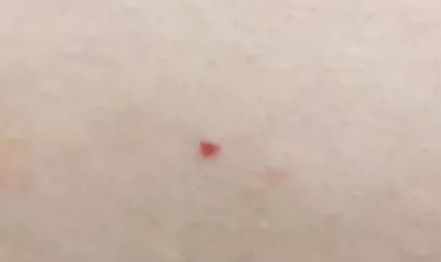 时事看点>正文> 小红点没有高出皮肤表面,轻压不退色,一般是毛细血管