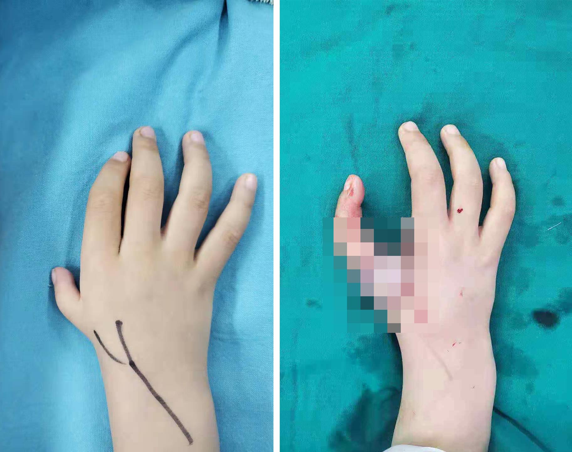 手术前（左）和手术后（右）  上海儿童医院供图 