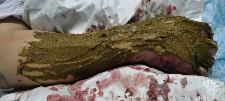 63岁大伯抓毒蛇泡药酒,反被咬一口!他立马用嘴吸伤口,最后躺进了医院……休闲区蓝鸢梦想 - Www.slyday.coM 63岁大伯抓毒蛇泡药酒,反被咬一口!他立马用嘴吸伤口,最后躺进了医院……休闲区蓝鸢梦想 - Www.slyday.coM